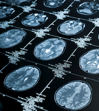 MRI scan
